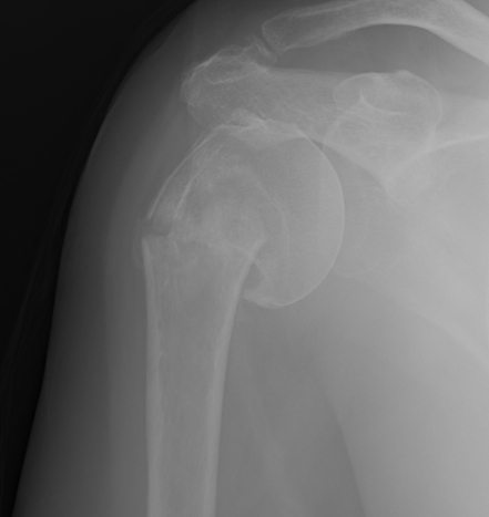 Displaced Proximal Humeral Fracture